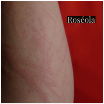 roseola pediatra promatre
